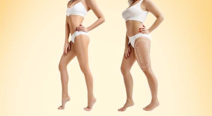 liposuction